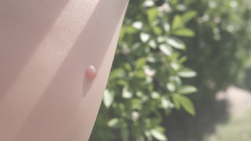 Kiedy należy skonsultować się z lekarzem po ukąszeniu komara?